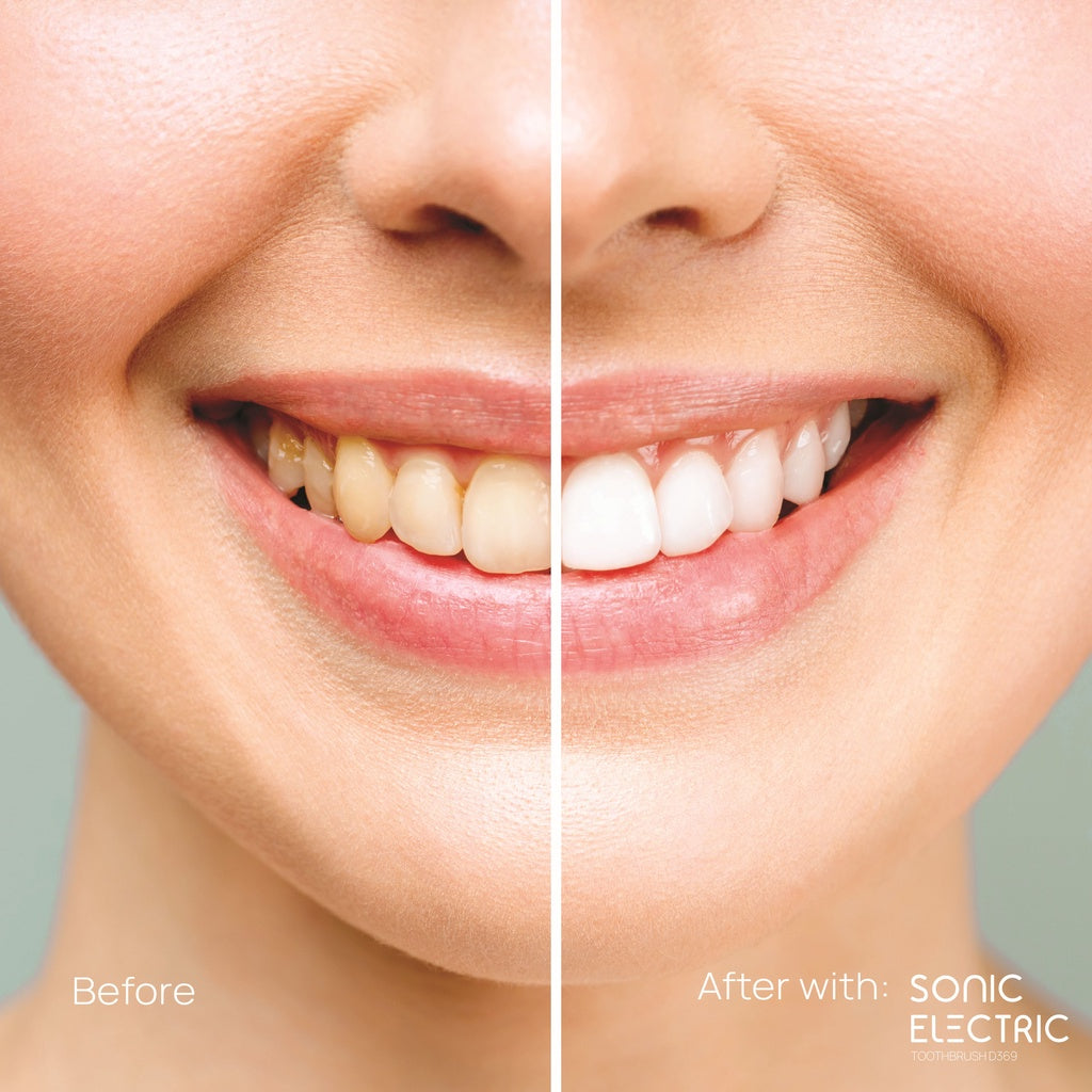 Sonic Electronic Toothbrush (5 Mode) – Dentiste